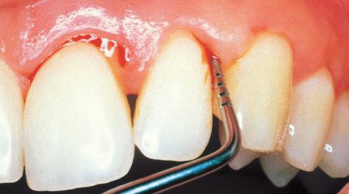 Cạo vôi răng có tác dụng gì - Nha khoa tư vấn 2