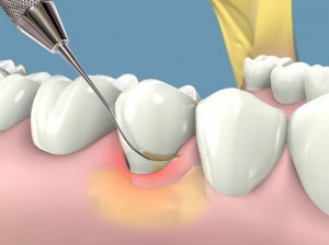 Quá trình cạo vôi răng có bị chảy máu không? 1