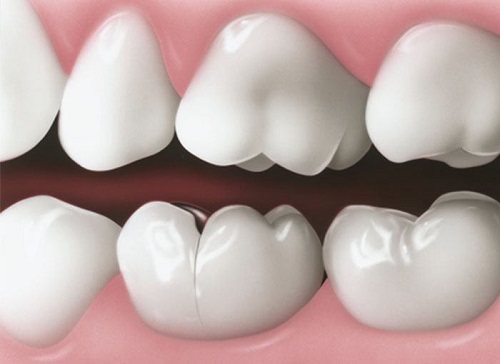 Nguyên nhân cần bọc răng sứ cho răng hàm1