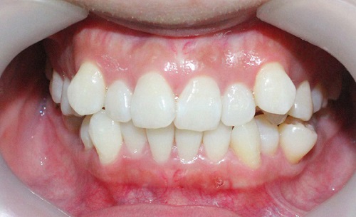 Quá trình bọc răng sứ cho răng khấp khểnh  1