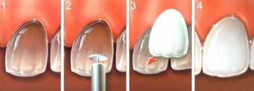 Quá trình bọc răng sứ cho răng khấp khểnh3