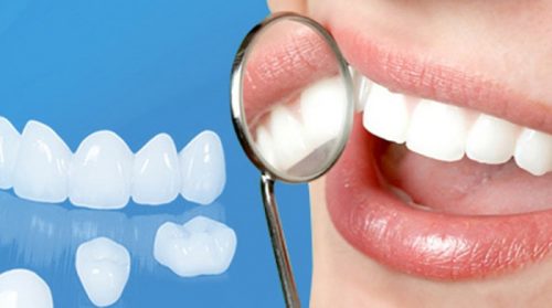 Độ bền của răng sứ thẩm mỹ là bao lâu? 1