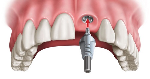 Kỹ thuật trồng răng implant diễn ra như thế nào ?2