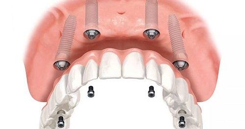Kỹ thuật trồng răng implant diễn ra như thế nào ? 3