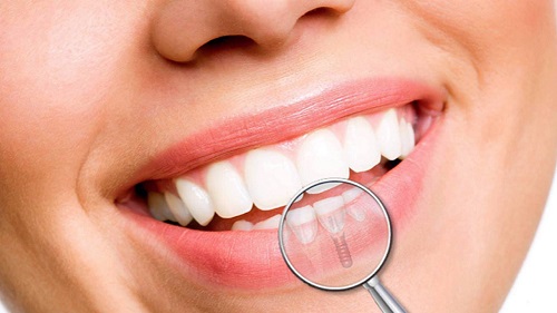 Kỹ thuật trồng răng implant diễn ra như thế nào ?1