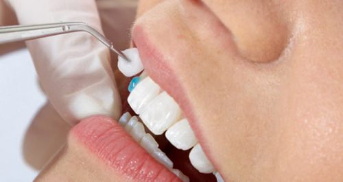 Răng bọc sứ bị lung lay phải làm sao? Cần hướng giải quyết từ nha khoa 1