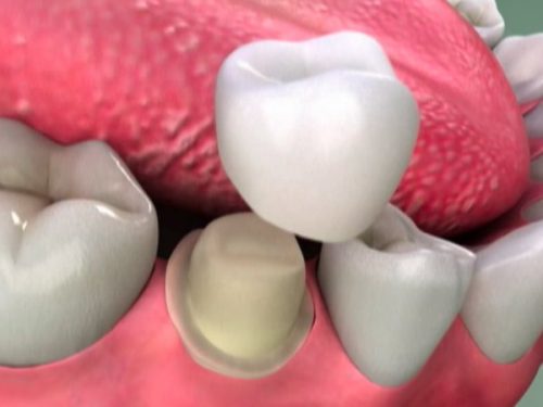 Răng sứ bị mẻ vỡ phải làm sao để xử lý tình trạng này? 3