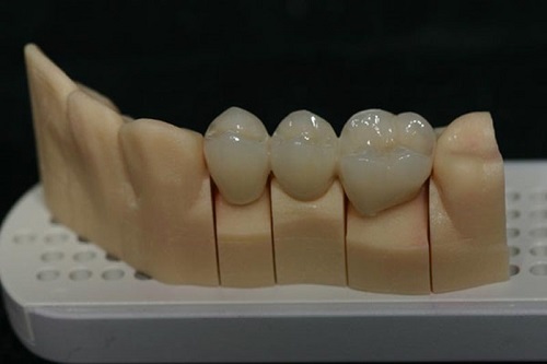 Trồng răng hàm có đau không? Các biện pháp xử lý 1