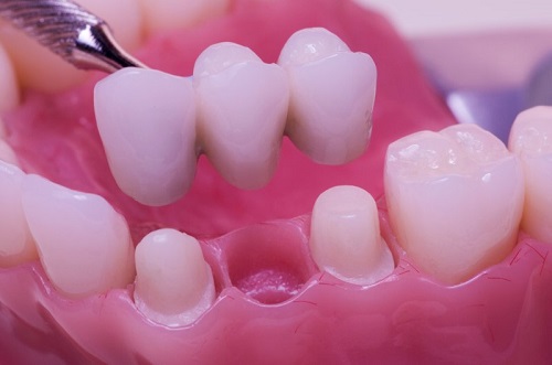 Trồng răng hàm có đau không? Các biện pháp xử lý 2