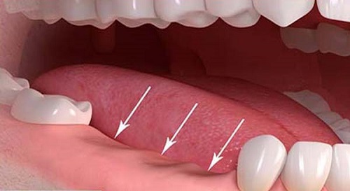 Trồng răng implant ở đâu tốt? Tư vấn hỗ trợ 1
