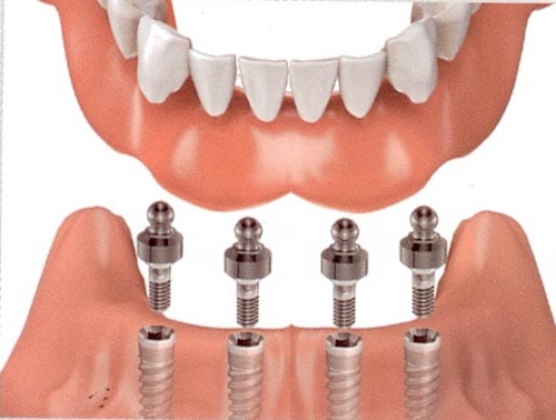 Trồng răng implant ở đâu tốt? Tư vấn hỗ trợ 2