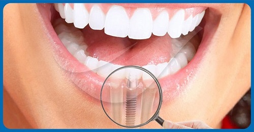 Trồng răng ở đâu thì tốt nhất và đảm bảo?3