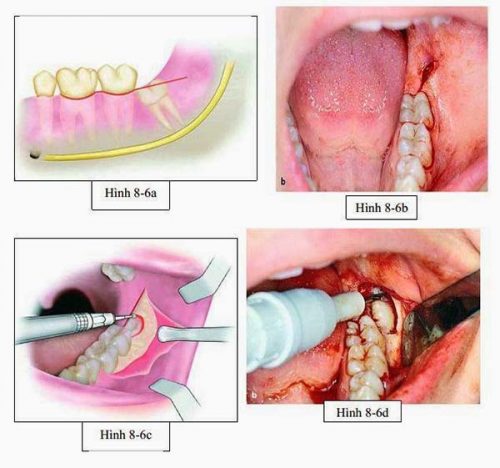 Răng khôn bị đau nhức thường xuyên - Có nên nhổ răng khôn không? 3