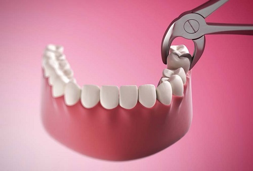 Nhổ răng khôn có đau không? Lưu ý gì sau khi nhổ răng khôn 3