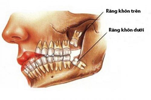 Nhổ răng khôn có ảnh hưởng gì không? 1