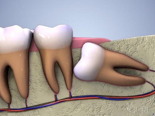 Răng khôn gây đau nhức cần phải làm gì giúp giảm đau? 2