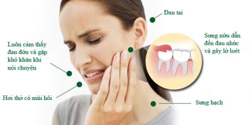 Phương pháp nhổ răng khôn không đau tại nha khoa uy tín 1