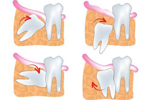 Phương pháp nhổ răng khôn không đau tại nha khoa uy tín 2