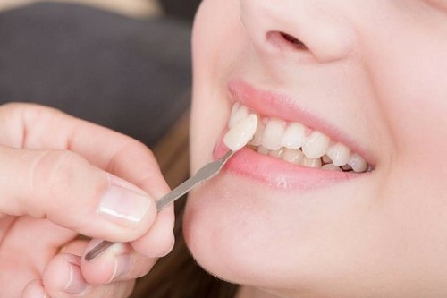 Bọc răng sứ ở đâu tốt nhất tphcm? Thông tin tìm hiểu 2