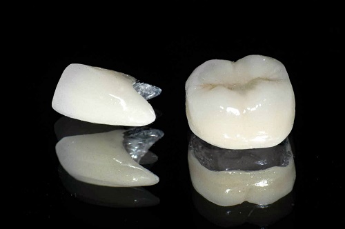 Bọc răng sứ titan có những ưu điểm gì vượt trội 1