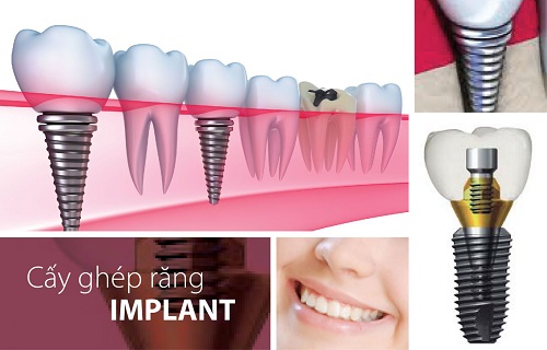 Cấy ghép implant có tốt không? Tìm hiểu thông tin 2 Cấy ghép implant có tốt không? Tìm hiểu thông tin 2