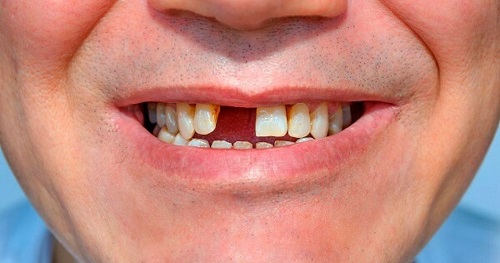 Cắm implant răng cửa như thế nào? 1