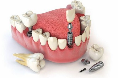 Cắm implant răng cửa khi nào? * Cắm implant răng cửa khi nào? 2