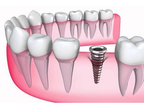Quy trình cấy ghép implant răng hàm cho bạn 1