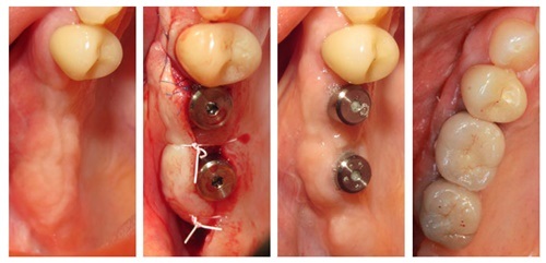 Quy trình cấy ghép implant răng hàm cho bạn 2