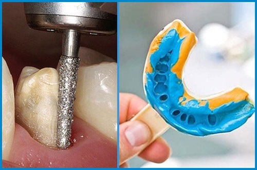 Quy trình cấy ghép implant răng hàm cho bạn 4