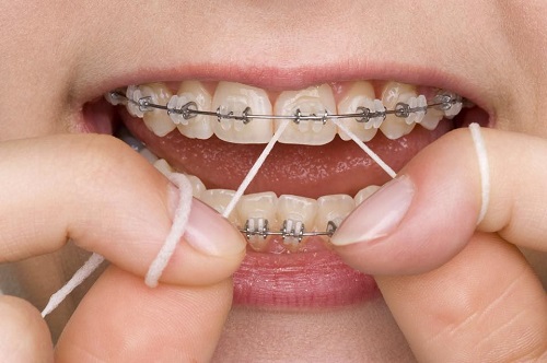 Niềng răng có nguy hiểm không? Lưu ý điều gì khi niềng răng 4