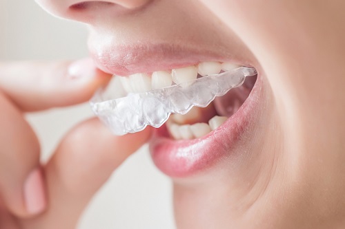Niềng răng có tốt không? Những lợi ích khi niềng răng 3