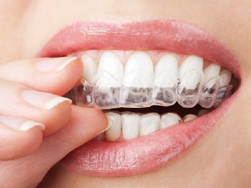 Bạn quan tâm - Niềng răng hàm trên bao nhiêu tiền 3