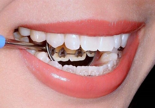 Niềng răng mắc cài mặt lưỡi có hiệu quả cao không 2