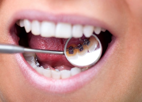 Niềng răng mắc cài mặt lưỡi có hiệu quả cao không 3
