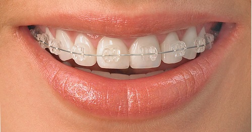 Niềng răng mắc cài pha lê hiệu quả ra sao? Ưu điểm chính là gì 1