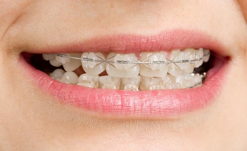 Niềng răng mắc cài pha lê hiệu quả ra sao? Ưu điểm chính là gì 2