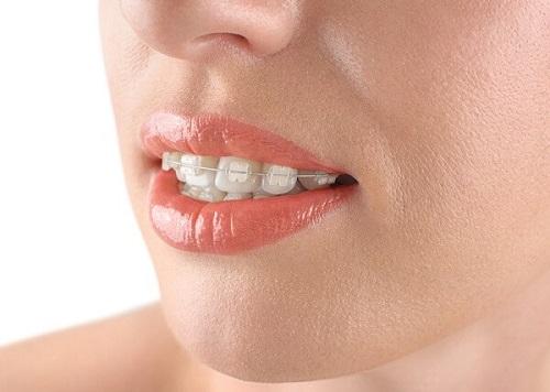 Niềng răng mắc cài pha lê hiệu quả ra sao? Ưu điểm chính là gì 3