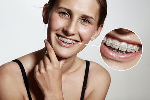 Niềng răng mắc cài pha lê hiệu quả ra sao? Ưu điểm chính là gì 4
