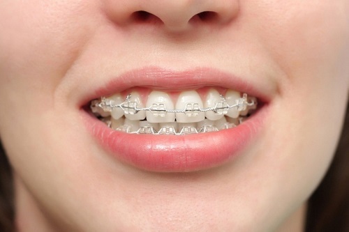 Niềng răng người lớn giá bao nhiêu tiền? Có đắt không 3 Niềng răng người lớn giá bao nhiêu tiền? Có đắt không 3