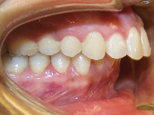 Phương pháp niềng răng sai khớp cắn - Bị sai khớp cắn do đâu 1