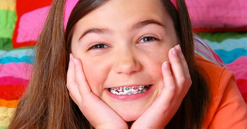 Niềng răng trẻ em giá bao nhiêu? Có biện pháp nào để tiết kiệm chi phí niềng không 2