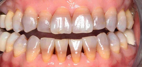 Tẩy trắng răng bị nhiễm tetracycline thực sự đem lại kết quả cao 1