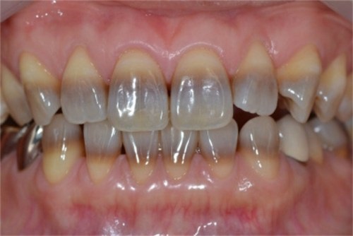 Tẩy trắng răng bị nhiễm tetracycline thực sự đem lại kết quả cao 2