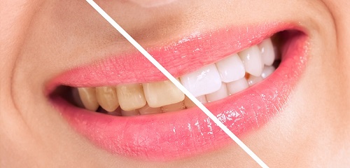 Tẩy trắng răng có đau không? Cần tìm hiểu thông tin gì trước khi tẩy trắng 1