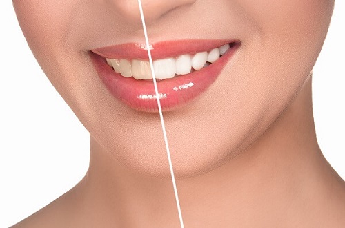 Tẩy trắng răng duy trì được bao lâu? Nha khoa tư vấn 2