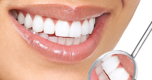 Tẩy trắng răng duy trì được bao lâu? Nha khoa tư vấn 3