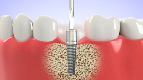 Thời gian cấy ghép implant trong bao lâu? 2 Thời gian cấy ghép implant trong bao lâu? 2