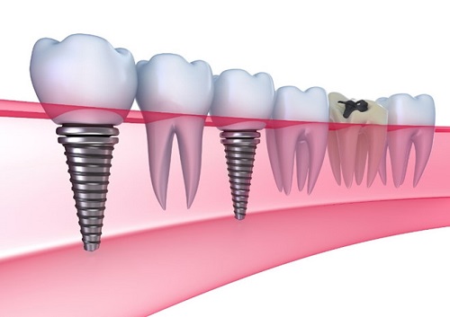 Trồng răng implant có đau không? Cần lưu ý gì  1