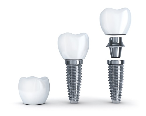 Trồng răng implant có đau không? Cần lưu ý gì 2